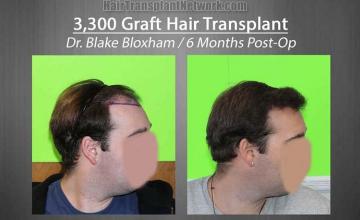 Hair restoration procedure before and after results photographs