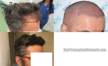 Hair restoration procedure before and after results