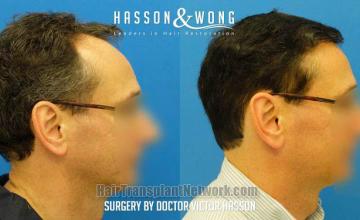 Hair restoration procedure before and after results