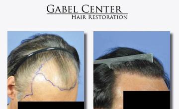 Hair transplant surgery before and after photos