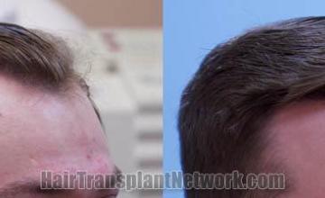 Hair transplantation procedure before and after results