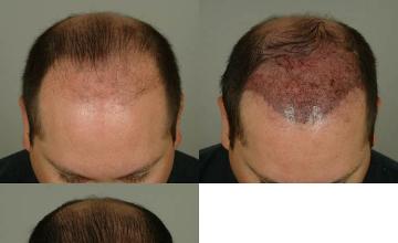 Hair transplantation surgery before and after pictures