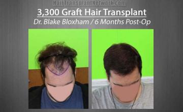 Hair transplantation surgery before and after images