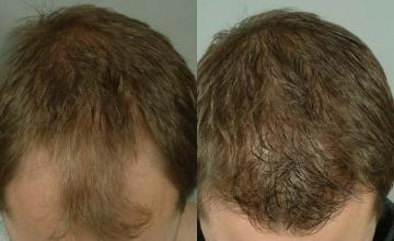 Before and after hair transplant procedure images