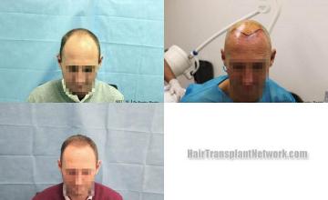 Hair transplantation surgery before and after photos