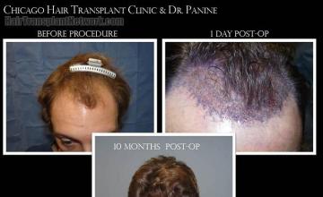 Top view - Before and after surgical hair replacement