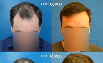 Hair transplantation surgery before and after photos