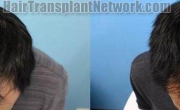 Hair restoration procedure before and after results