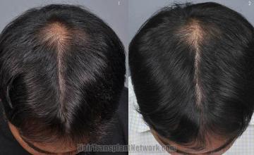 Top view before and after hair restoration results
