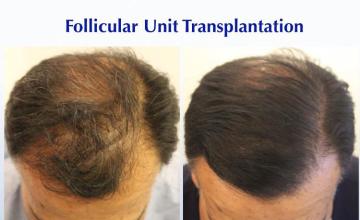 Top view - Before and after hair restoration procedure