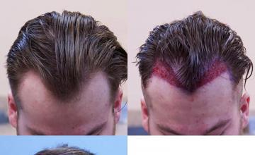 Before and after hair restoration procedure images