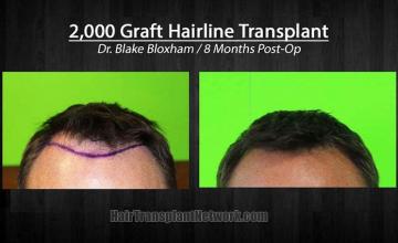 Hair restoration procedure before and after photographs