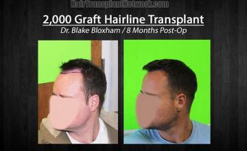 Hair transplantation repair surgery before and after photos