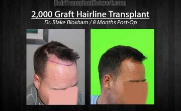 Hair restoration surgery before and after images