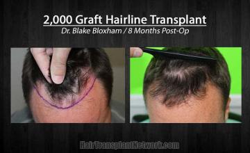 Before and after hair transplant procedure images