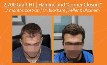 Hair restoration procedure before and after pictures