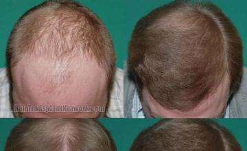 Top view before and after hair restoration results