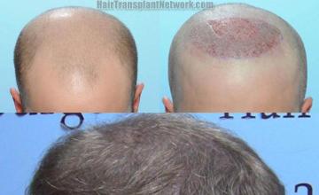  before and after photos