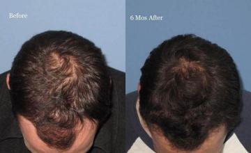 Before and after hair transplantation result photographs