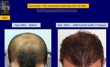 Hair transplantation surgery before and after photos