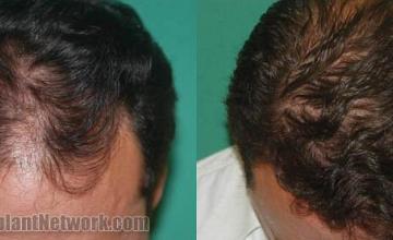 Hair transplantation surgery before and after images