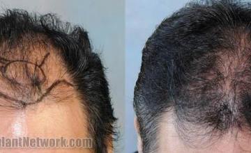 Hair restoration procedure before and after results