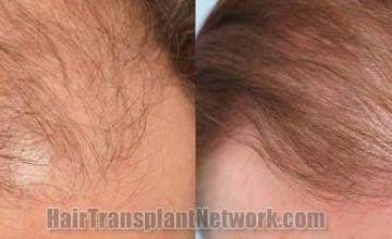 Hair restoration procedure before and after results