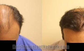 Top view before and after hair restoration results