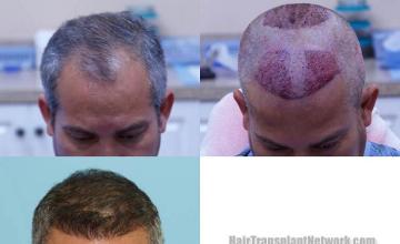 Hair restoration procedure before and after result photos