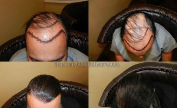 Hair restoration procedure before and after result images