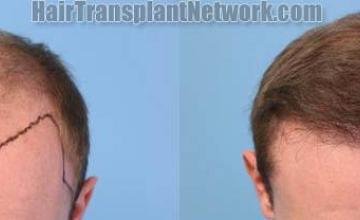 Hair restoration procedure before and after result photos