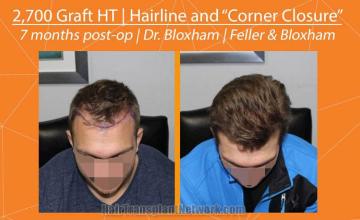 Hair transplantation surgery before and after images