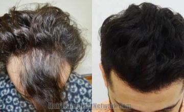 Hair transplantation surgery before and after images