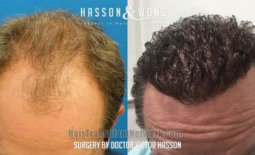 Before and after hair restoration procedure images