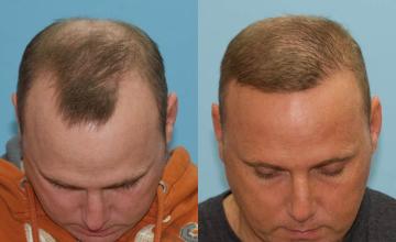 Before and after hair restoration procedure images