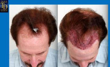 Hair transplantation surgery before and after photos