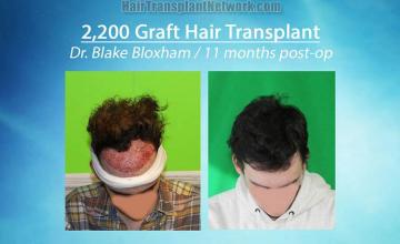 Before and after hair restoration procedure images