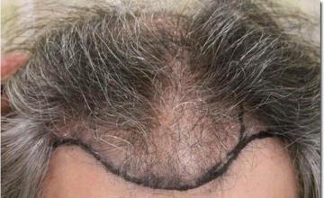 Hair restoration procedure results