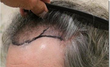 Hair restoration procedure results