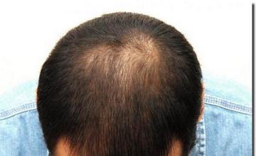 Hair restoration procedure results