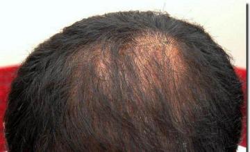 Hair restoration procedure results