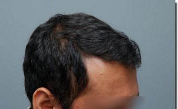 Hair restoration procedure results