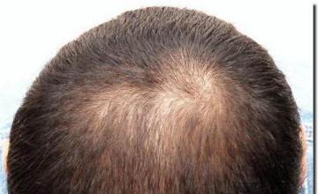 Hair restoration procedure results