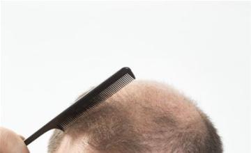 FUSS - Follicular Unit Strip Surgery | Hair Transplant Network FUSS - Follicular Unit Strip Surgery | Hair Transplant Network
