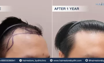Before and After