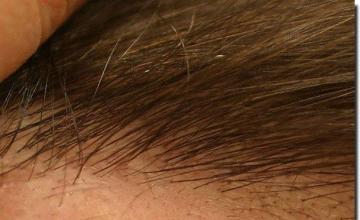 Hair restoration procedure results