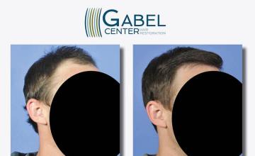 Hair restoration surgery before and after photos