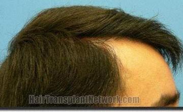 Hair restoration procedure results