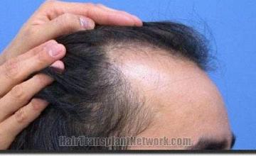 Hair restoration procedure results