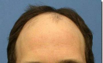 Hair restoration procedure results